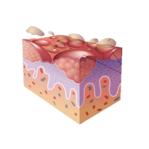 DME15 I Ekzeme