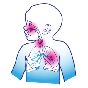 PL01 I Atemwegsinfektionen bei Kindern