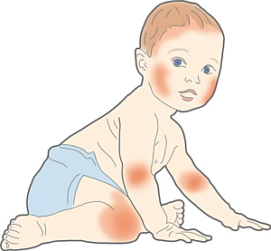 PO03 I Atopische Dermatitis und Ekzeme bei Kindern