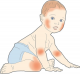 PP03 I Atopische Dermatitis und Ekzeme bei Kindern
