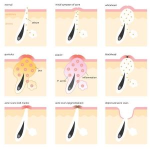 DO03 I Acne vulgaris