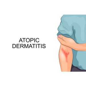 DP11 I Atopische Dermatitis